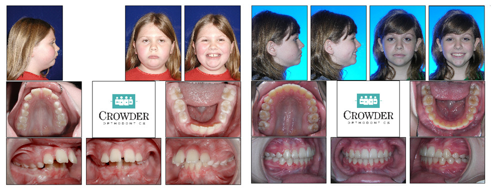 overbite before and after