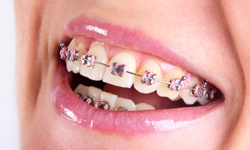 Braces - Orthodontist Dothan and Ozark, AL